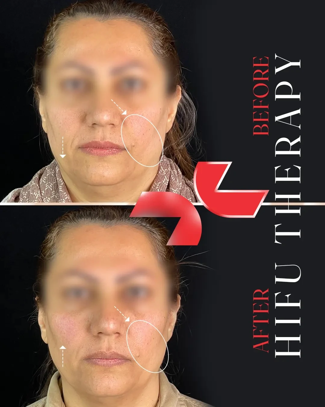 هایفوتراپی - Image