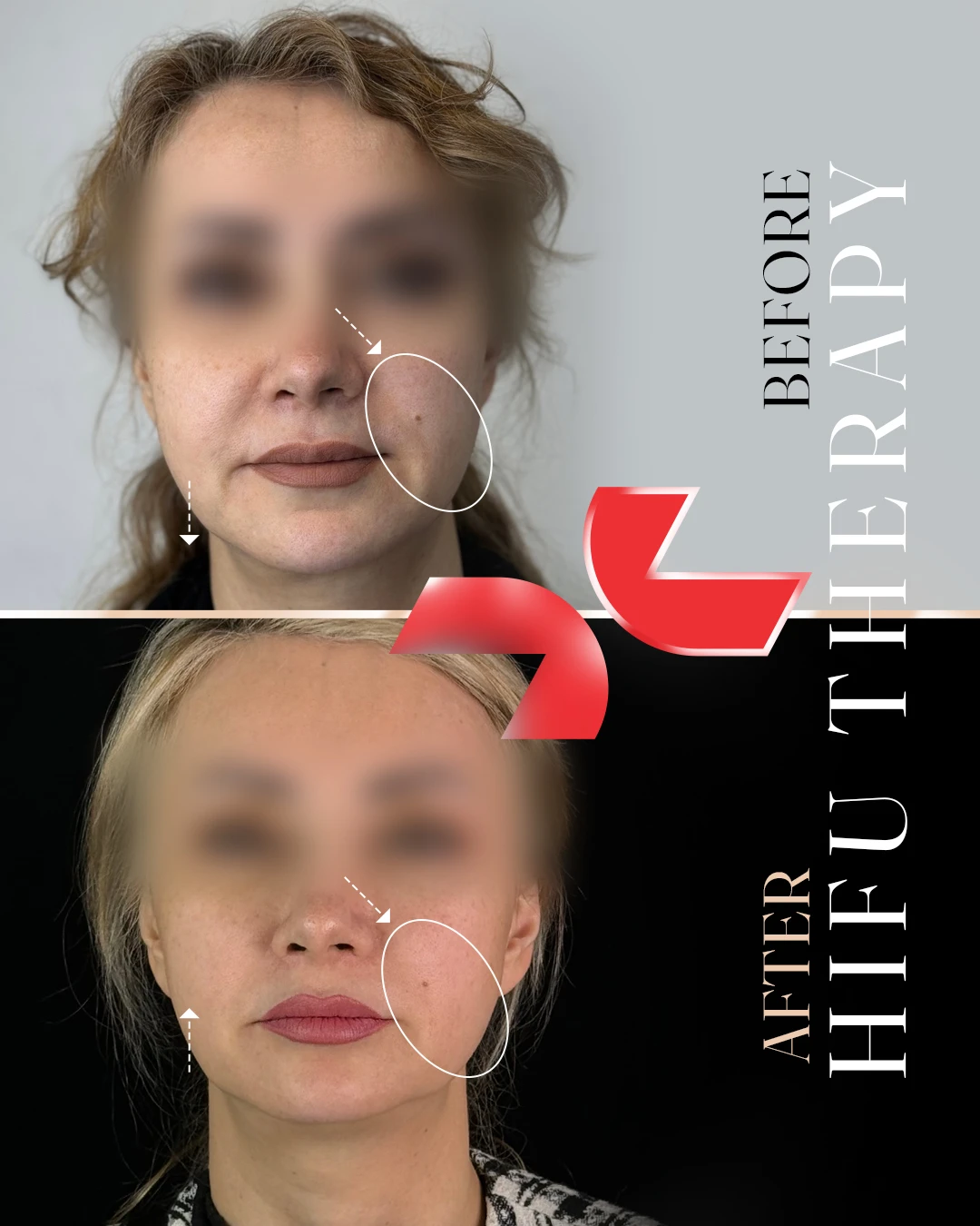 هایفوتراپی - Image