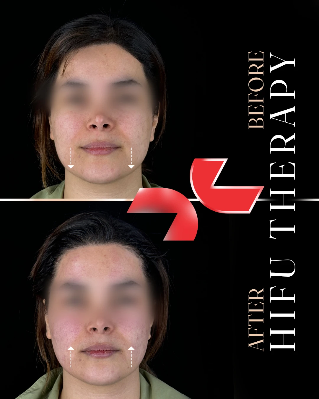 هایفوتراپی - Image