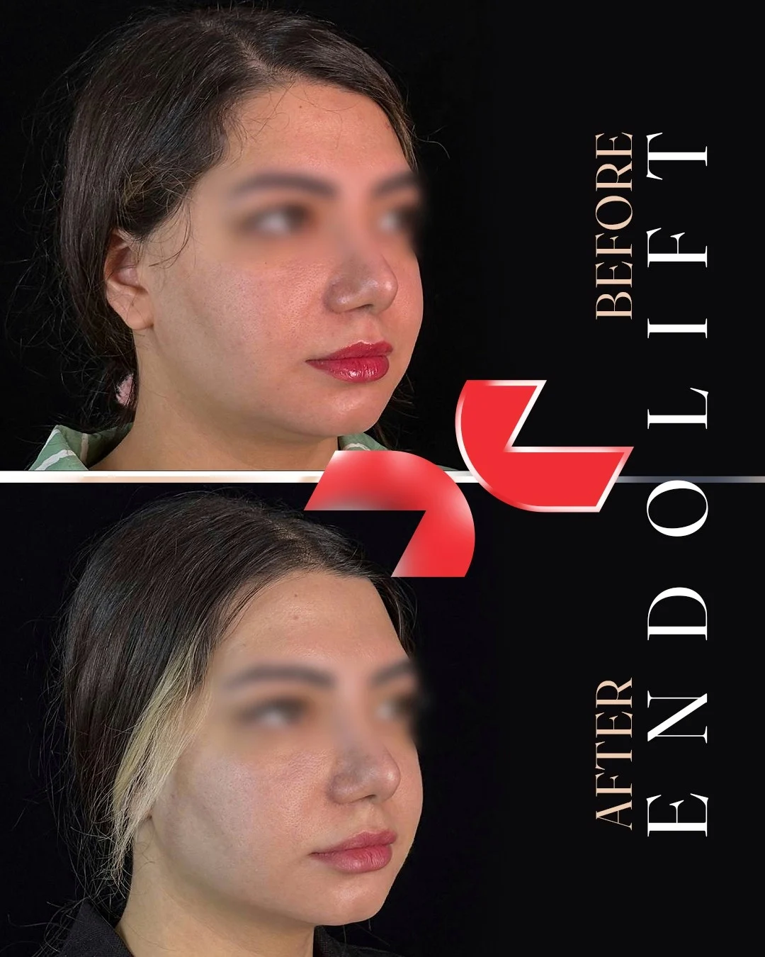 اندولیفت - Image