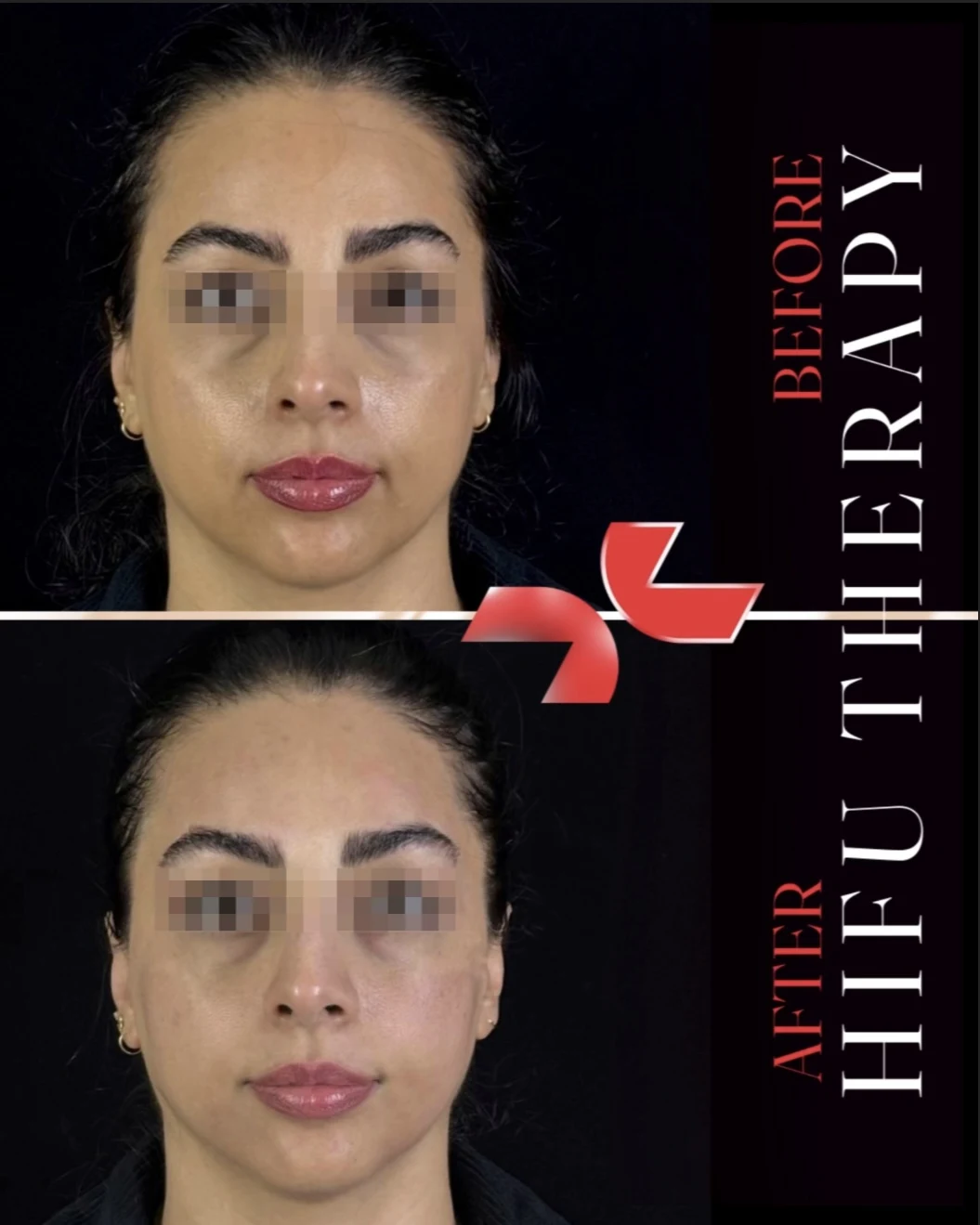 هایفوتراپی - Image