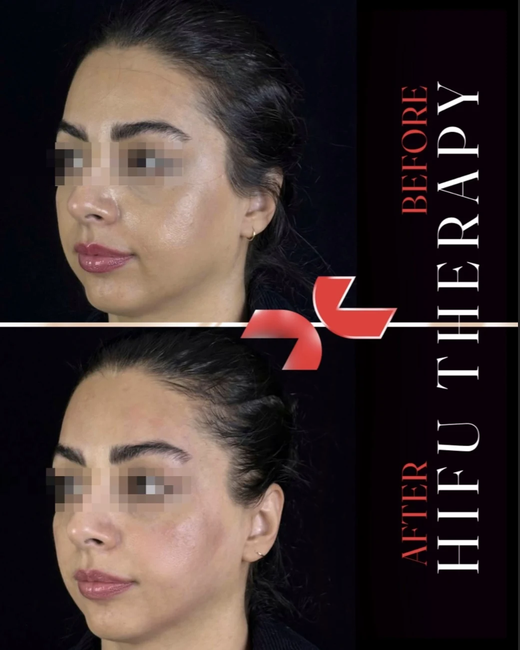 هایفوتراپی - Image