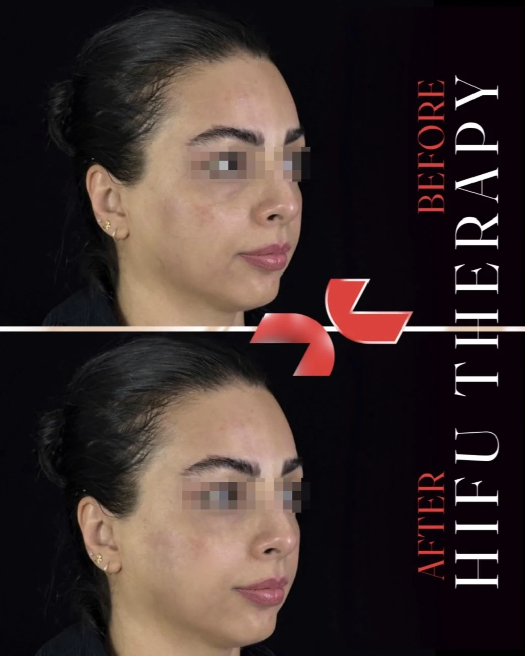 هایفوتراپی - Image