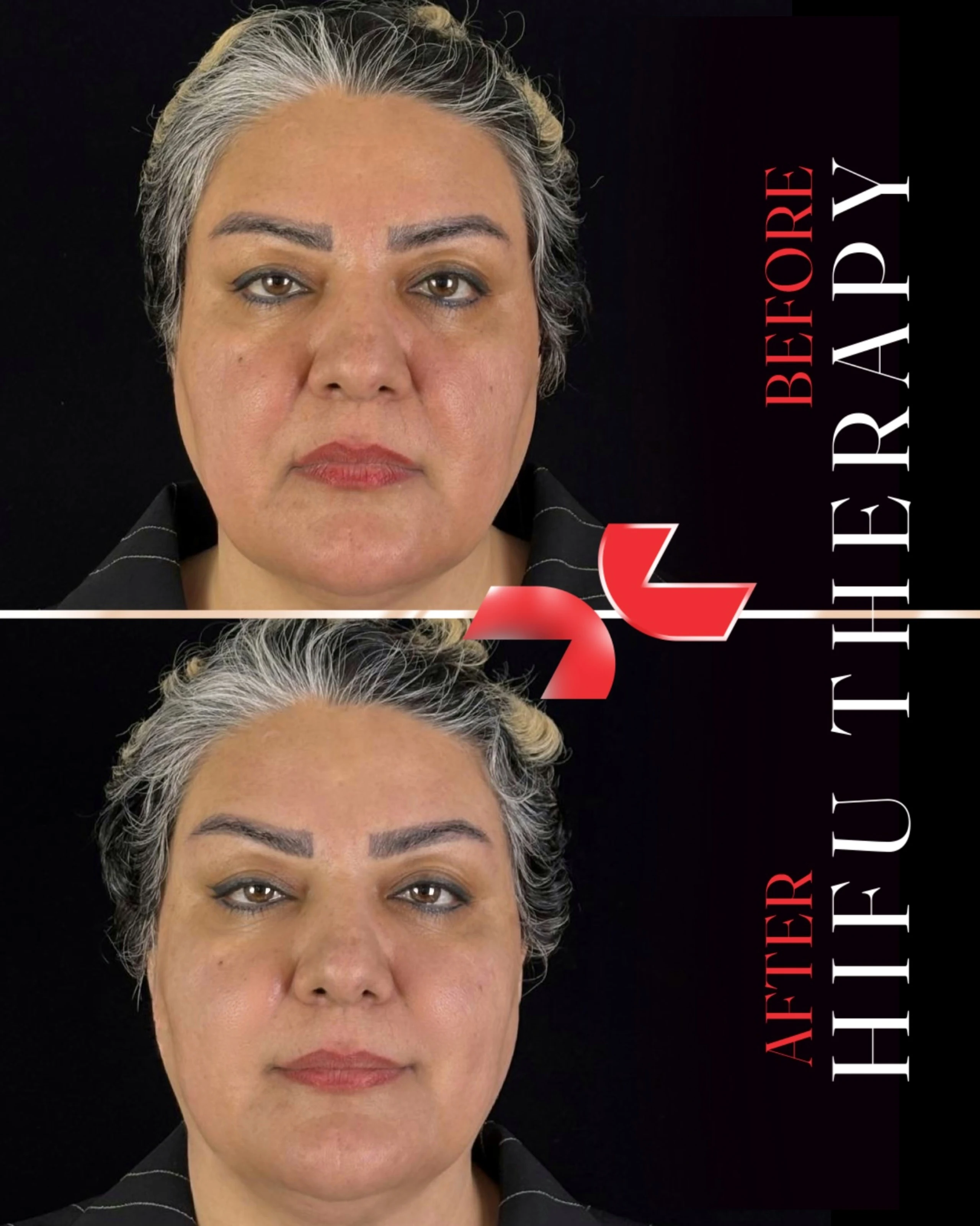 هایفوتراپی - Image