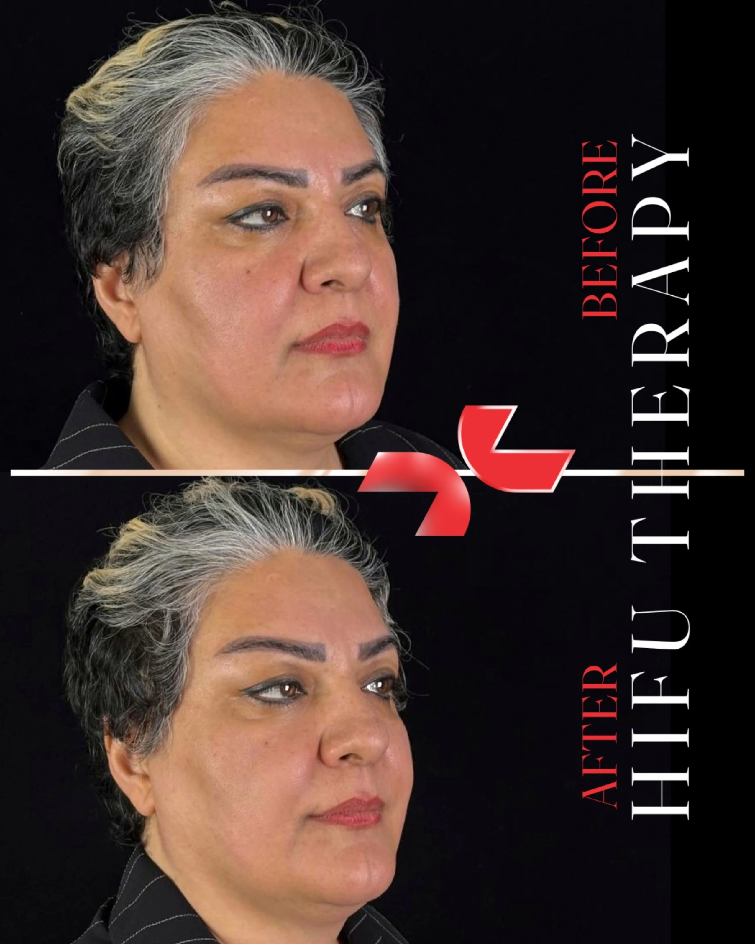 هایفوتراپی - Image