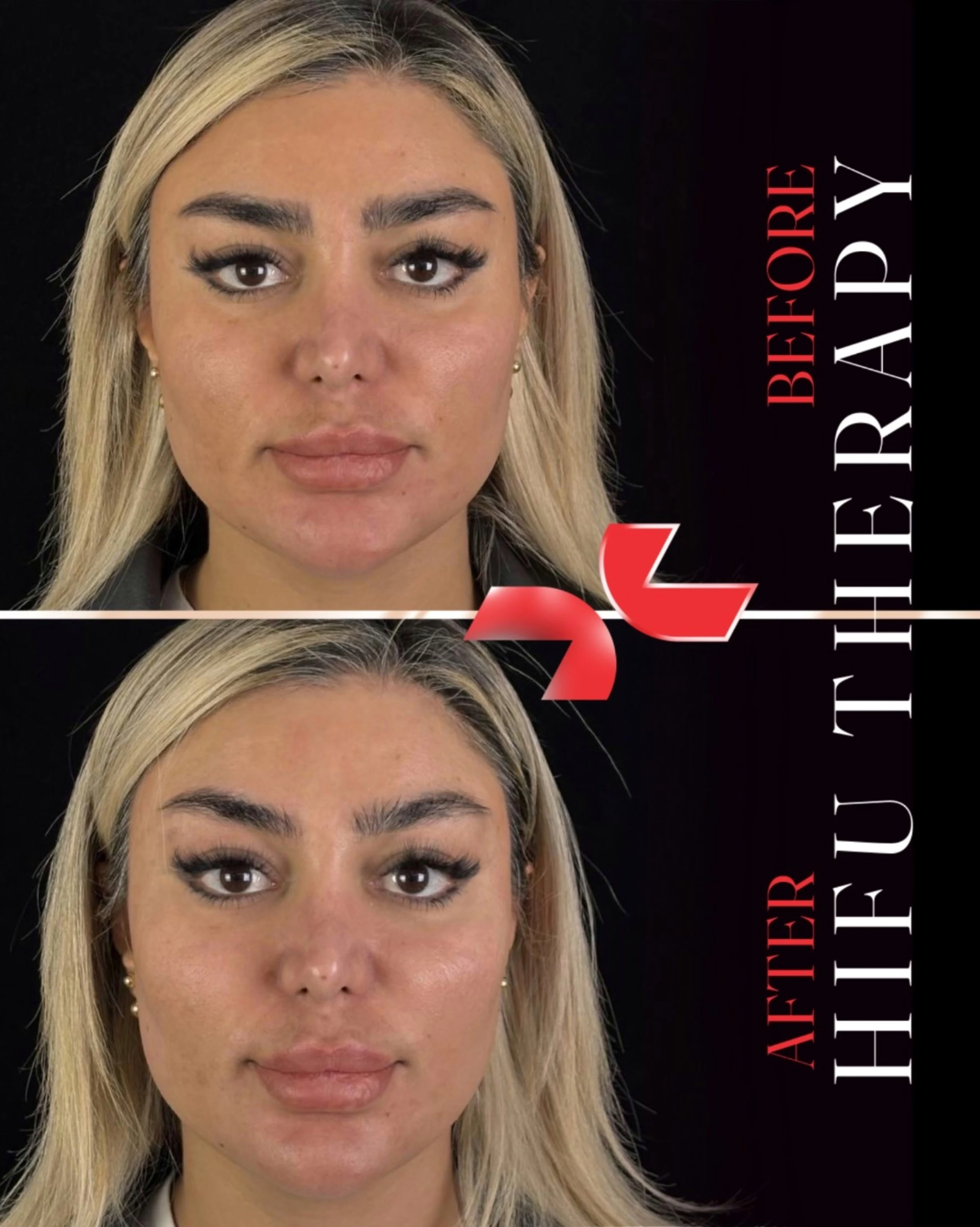 هایفوتراپی - Image