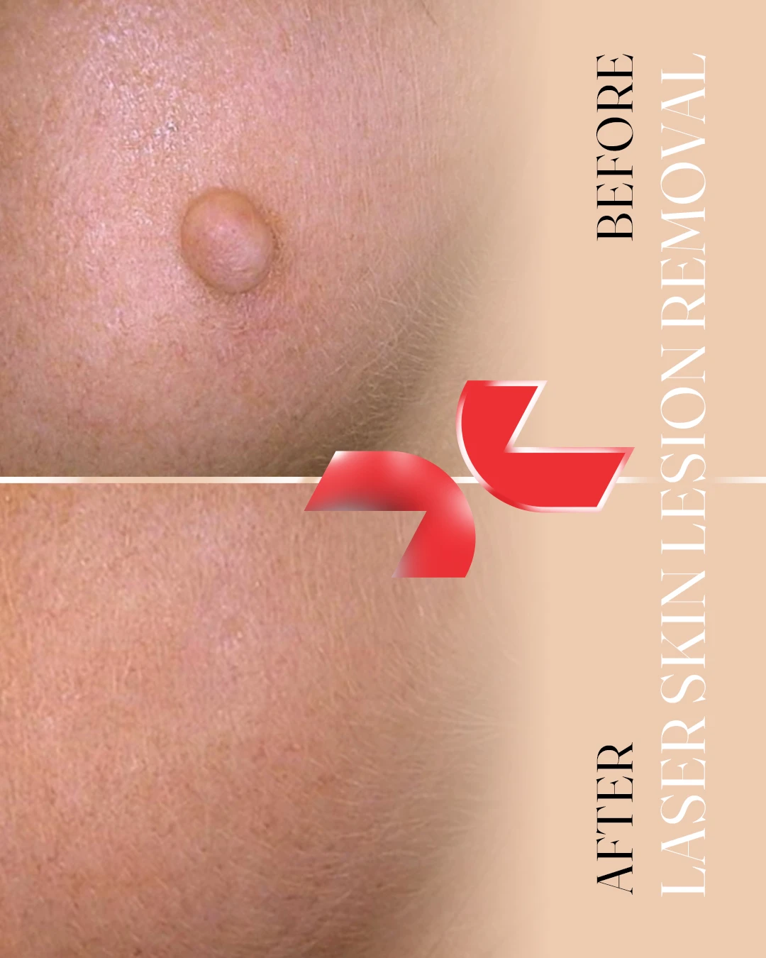 لیزر Dermablate آلمان - Image