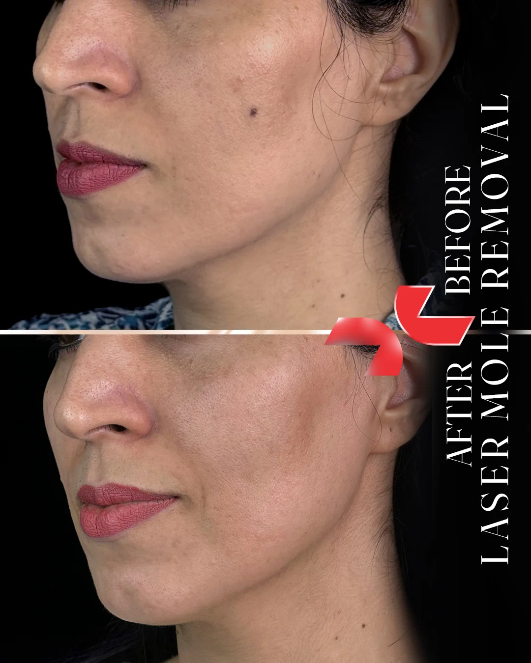 لیزر Dermablate آلمان - Image