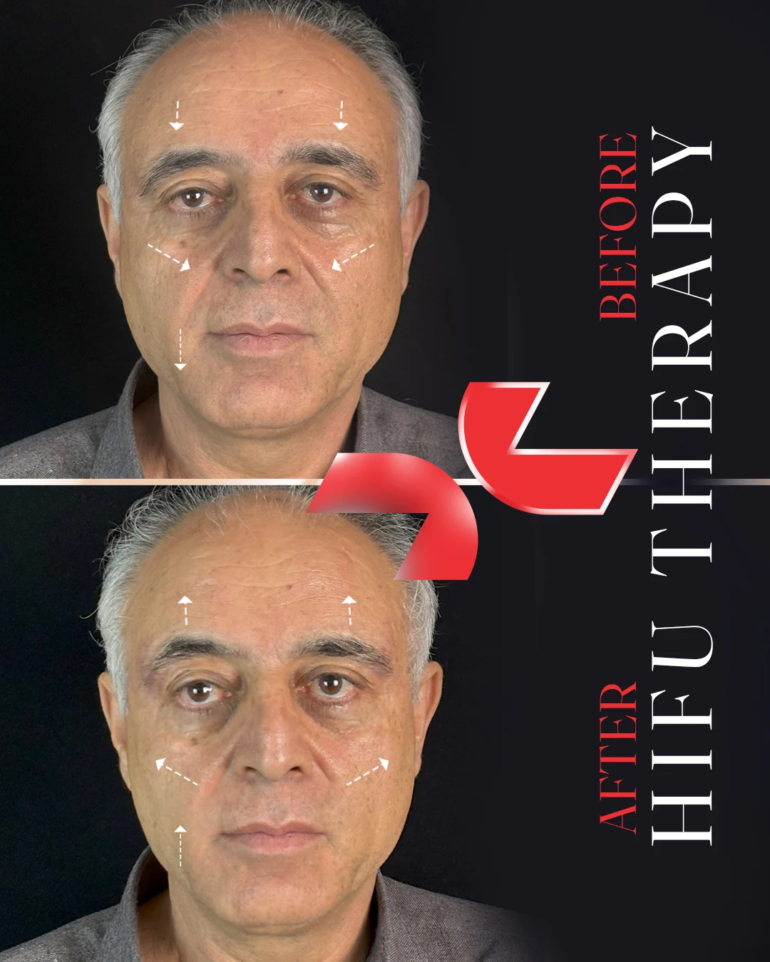 هایفوتراپی - Image