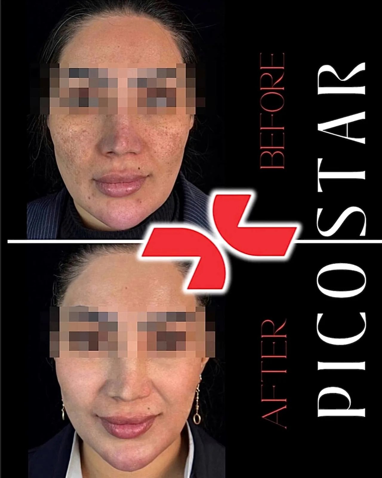 لیزر Pico Star آلمان - Image