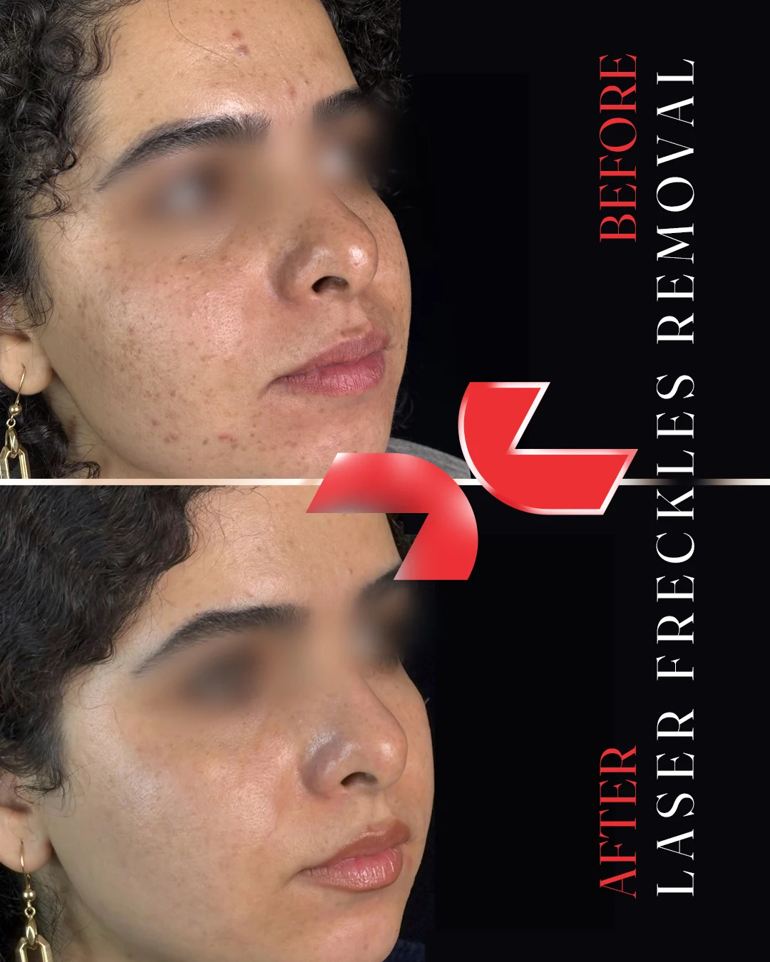 لیزر Pico Star آلمان - Image