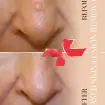 رفع ضایعات پوستی