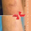 لیزر جای زخم