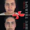 هایفوتراپی