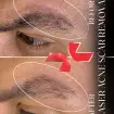 رفع جای زخم