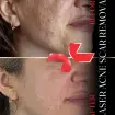 رفع جای جوش