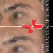 رفع جای زخم