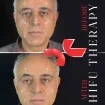 جوانسازی با هایفوتراپی + بوتاکس آپر و لیفت